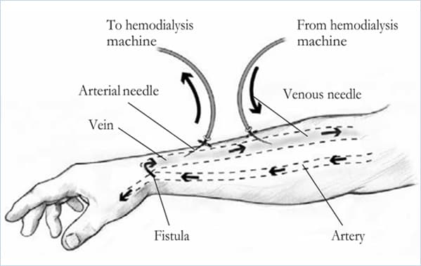 ARTERIOVENOUS FISTULA Image 1