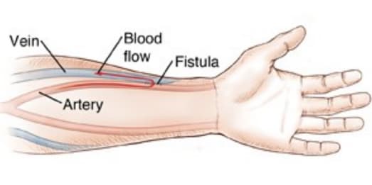 ARTERIOVENOUS FISTULA Image 2