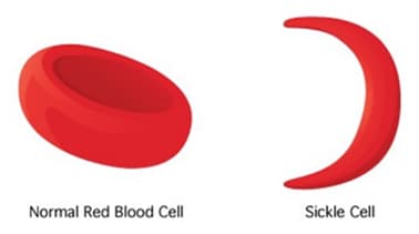 sickle-Cell Anemia Image 3