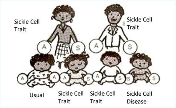Diagram showing how the normal hemoglobin-A (HbA) and the abnormal hemoglobin-S (HbS) is passed by parents. Both parents are carriers.