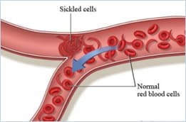 sickle-Cell Anemia Image 4