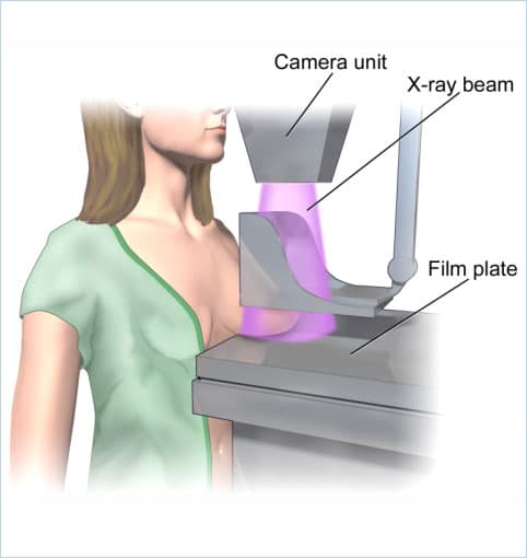 Mammography image 1