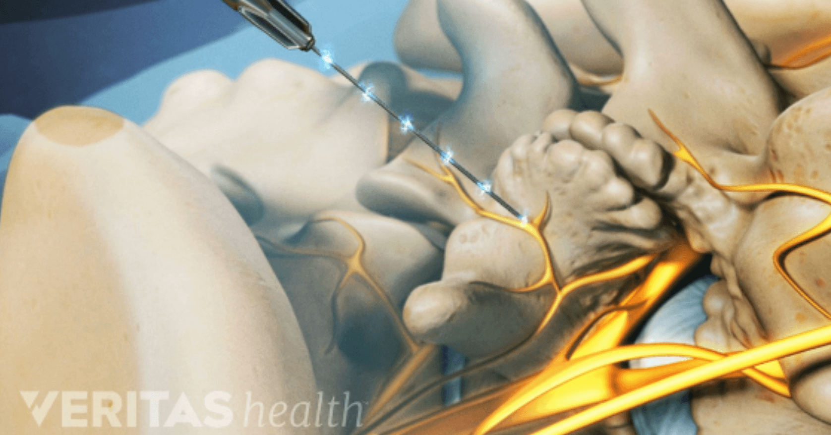 Sacroiliac (SI) Joint Block Image 5