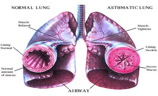 Image of Asthma 1