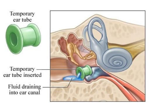 EAR TUBES image 3