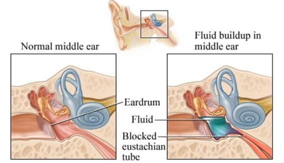 EAR TUBES image 4