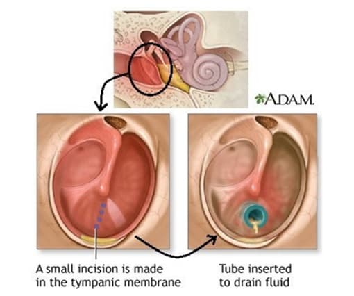 EAR TUBES image 5