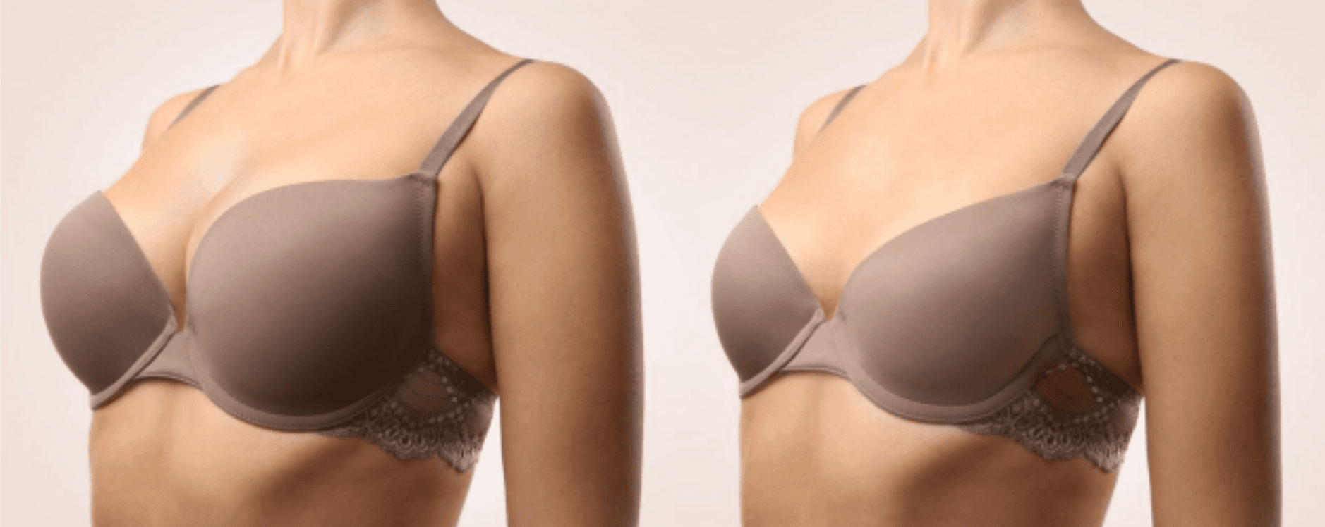 Breast Reduction Surgery Image 1