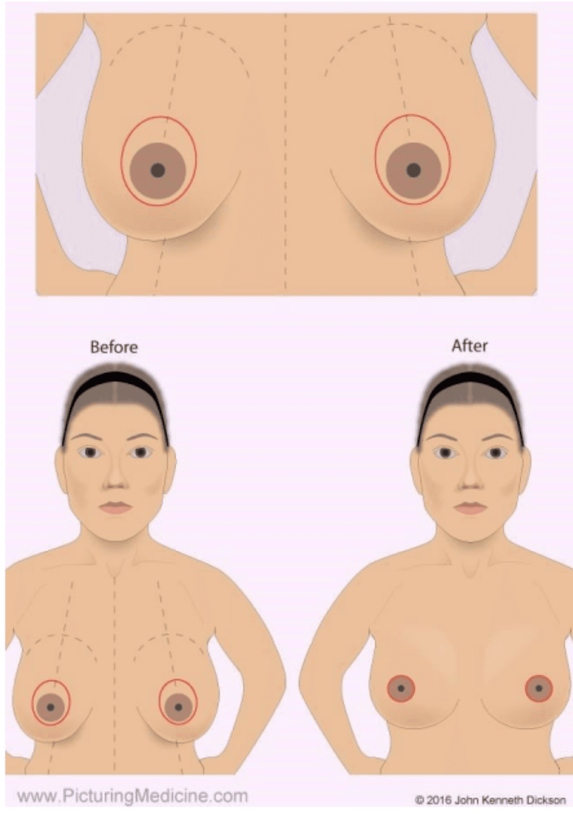 Breast Reduction Surgery Image 3