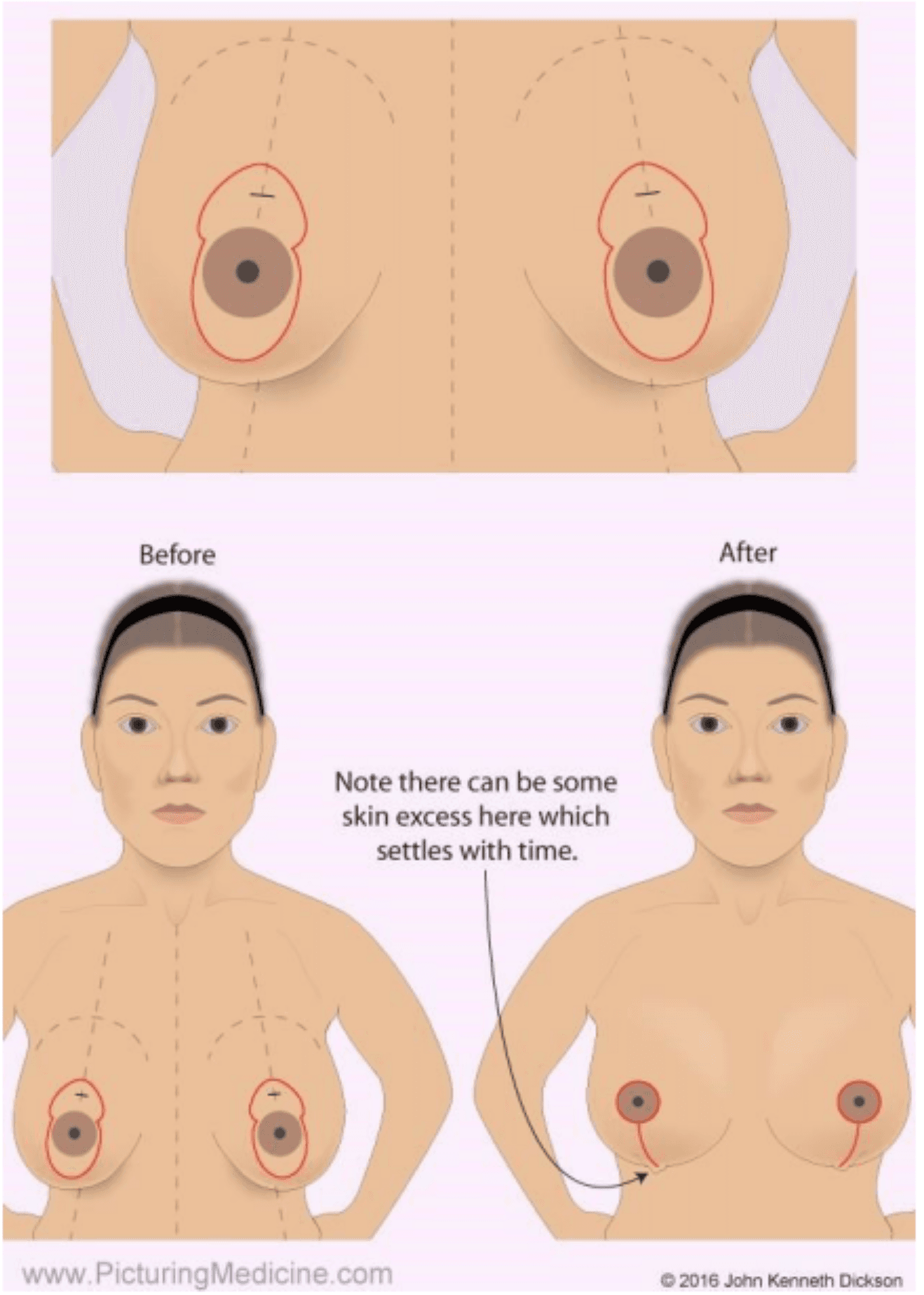 Breast Reduction Surgery Image 4