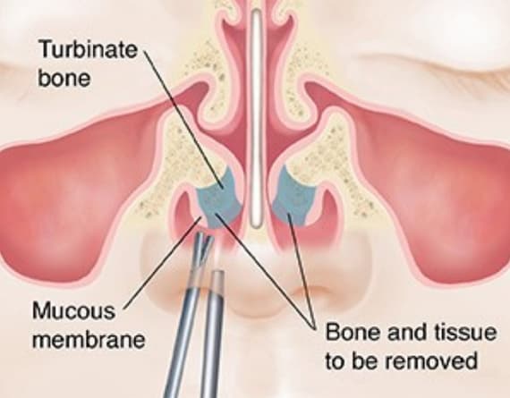 TURBINATES SURGERY image 3