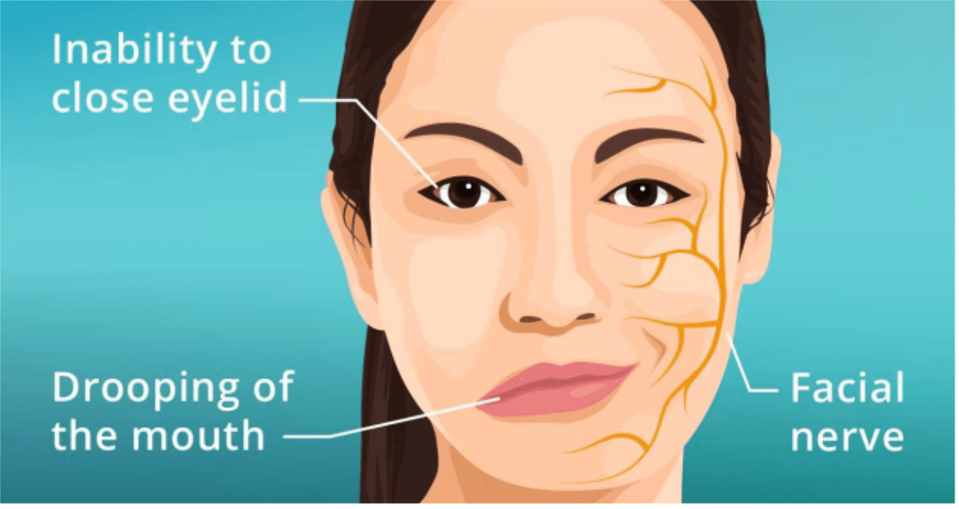Bell’s Palsy Image 1