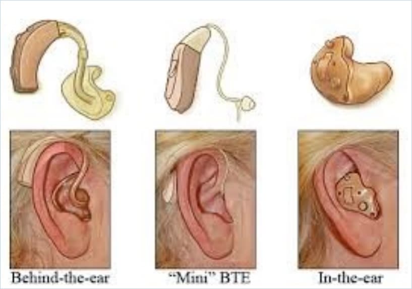 CONDUCTIVE HEARING LOSS image 4