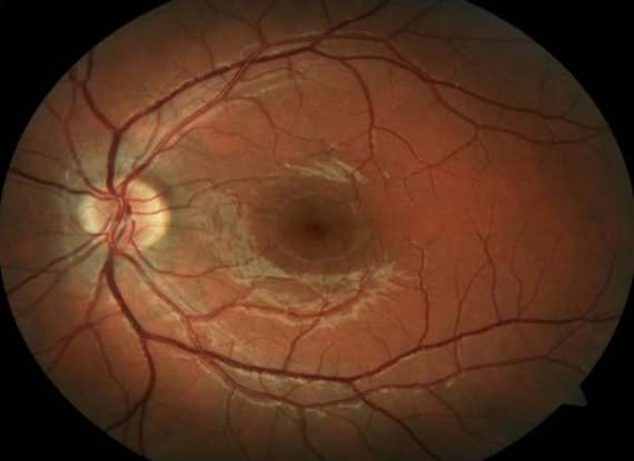 Fluorescein Angiography (FAG) Image 1