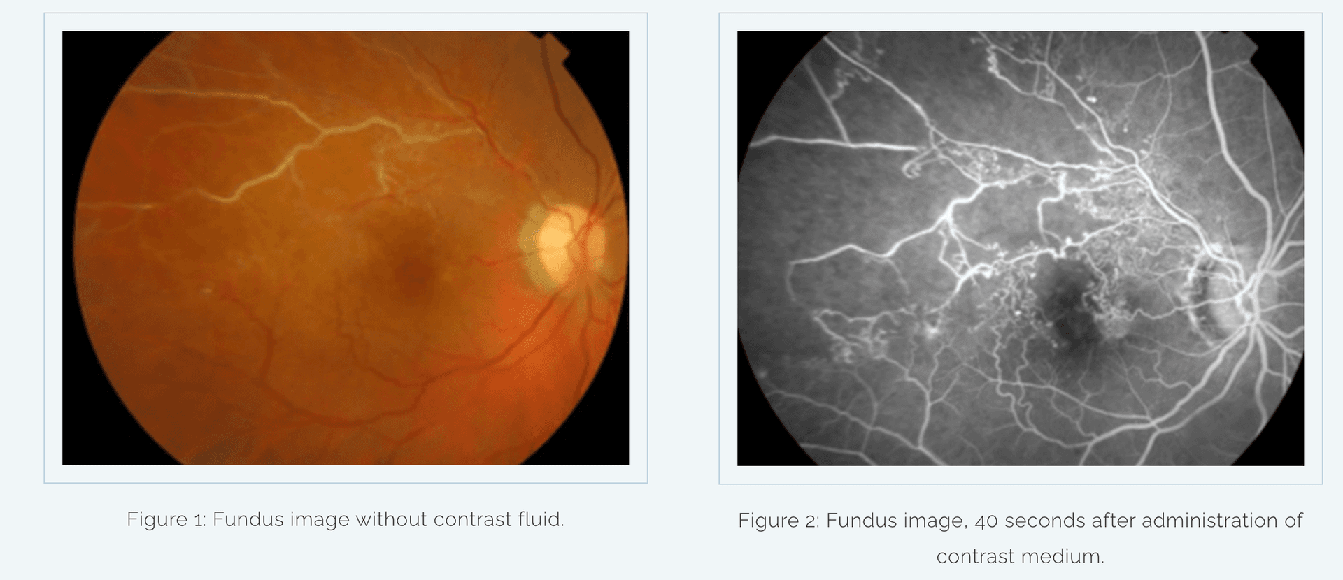 Fluorescein Angiography (FAG) Image 2