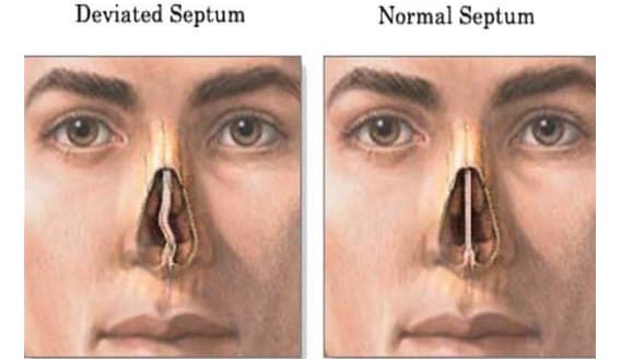 DEVIATED SEPTUM image 1