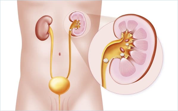 KIDNEY STONES image 1
