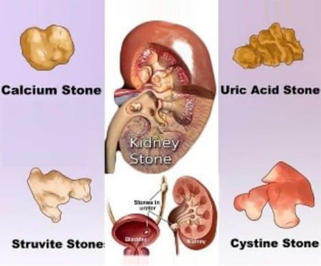 KIDNEY STONES image 2
