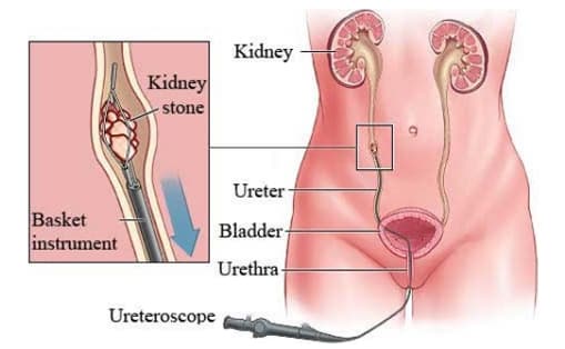 KIDNEY STONES image 4