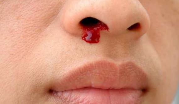 NOSEBLEED image 1