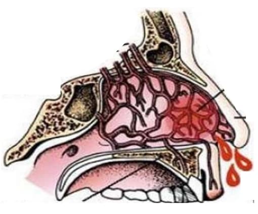 NOSEBLEED image 4