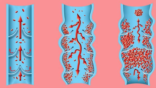 pulmonary embolism image 2