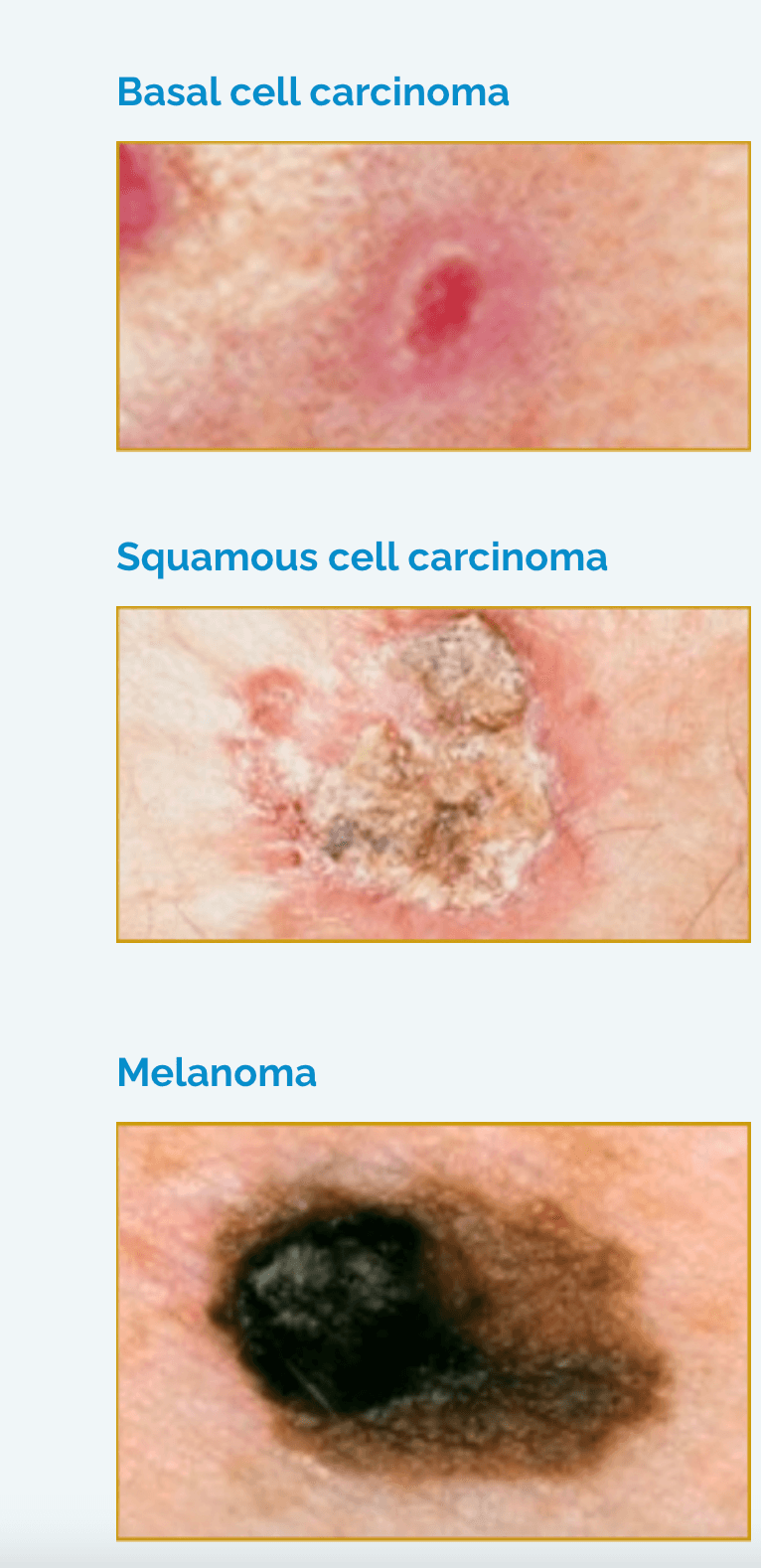 Skin Cancer Image 2