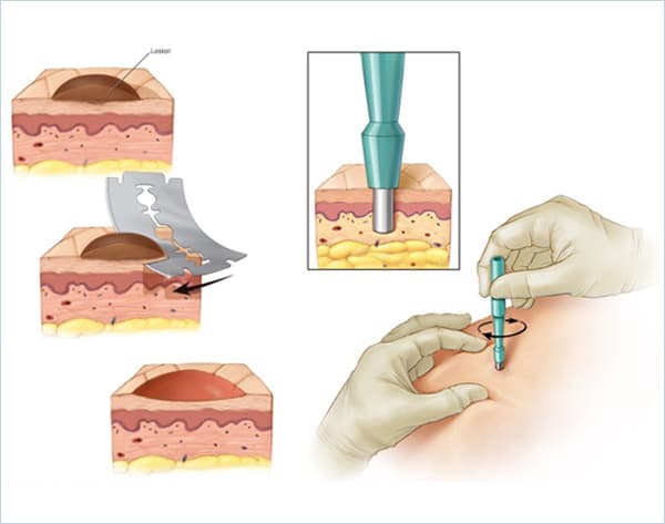 Skin Cancer Image 3