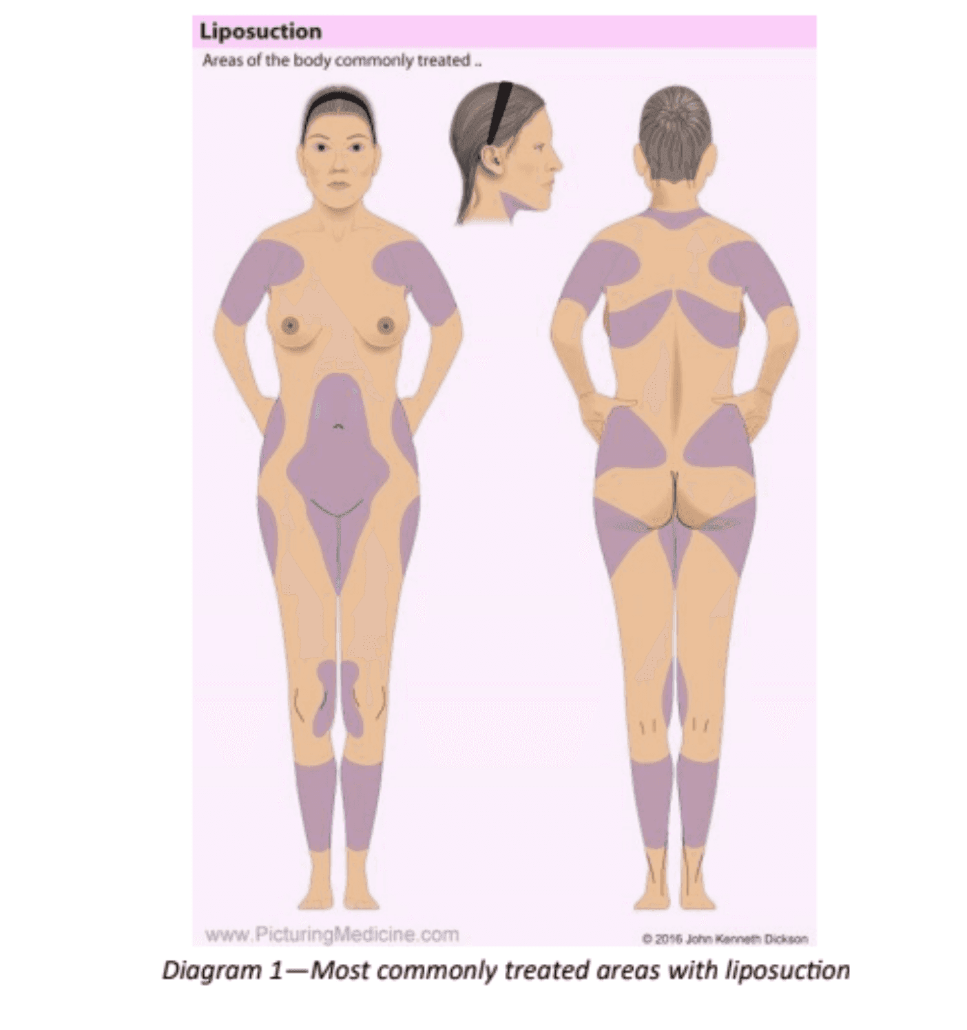 Cirugía de liposucción image 1