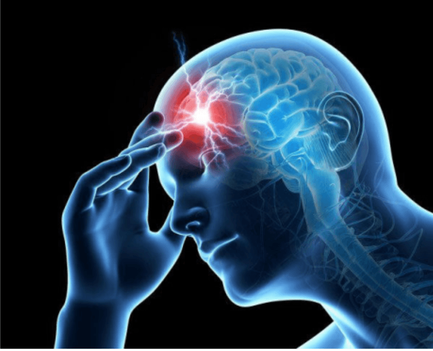 Migraine Image 1