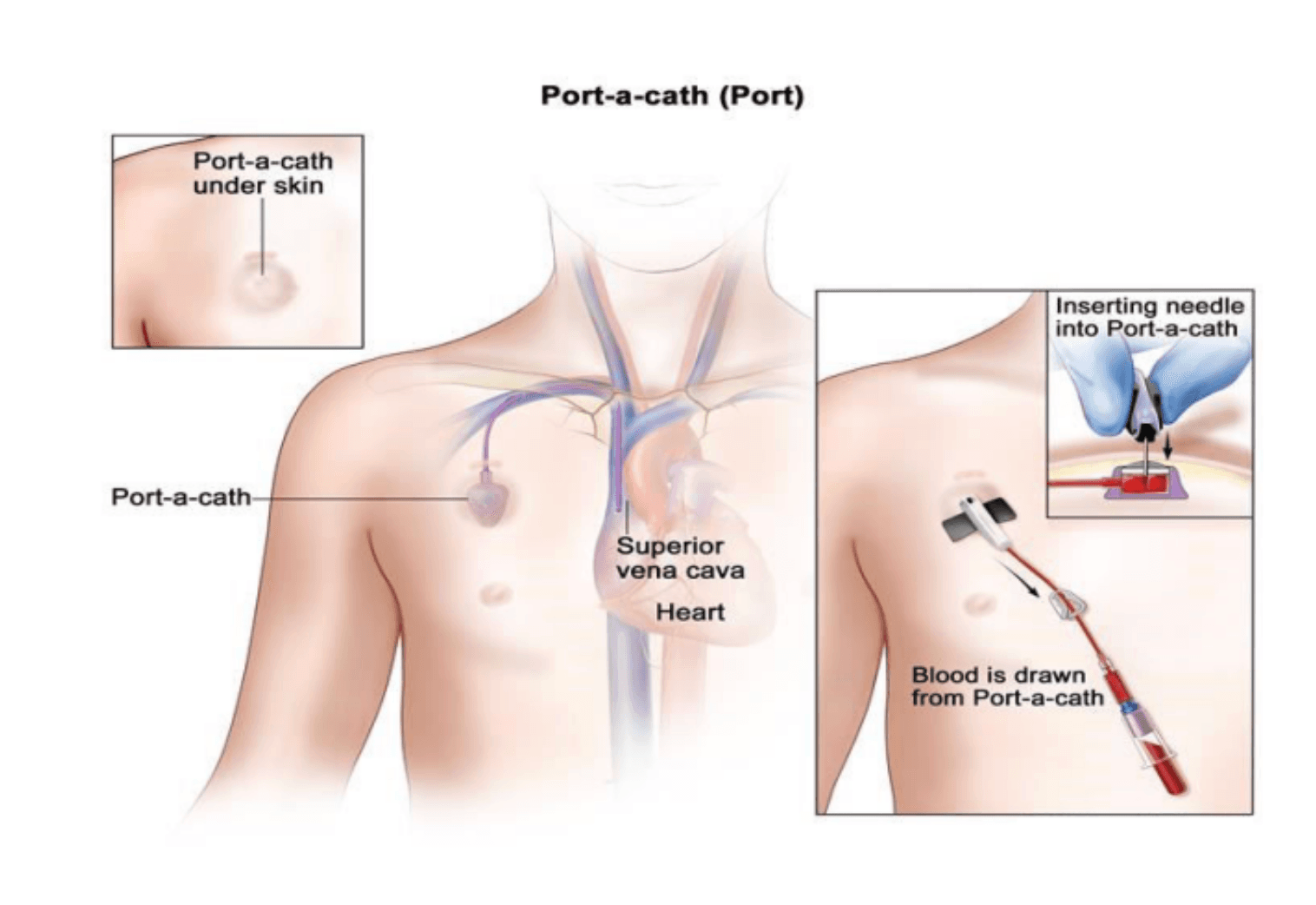 Port-A-Cath Image 1