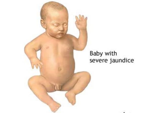 Image of Neonatal Jaundice