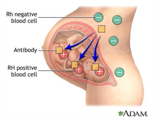 Image of Neonatal Jaundice 2