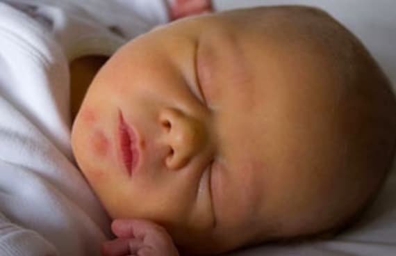 Image of Neonatal Jaundice 3
