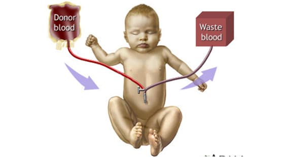 Image of Neonatal Jaundice 5
