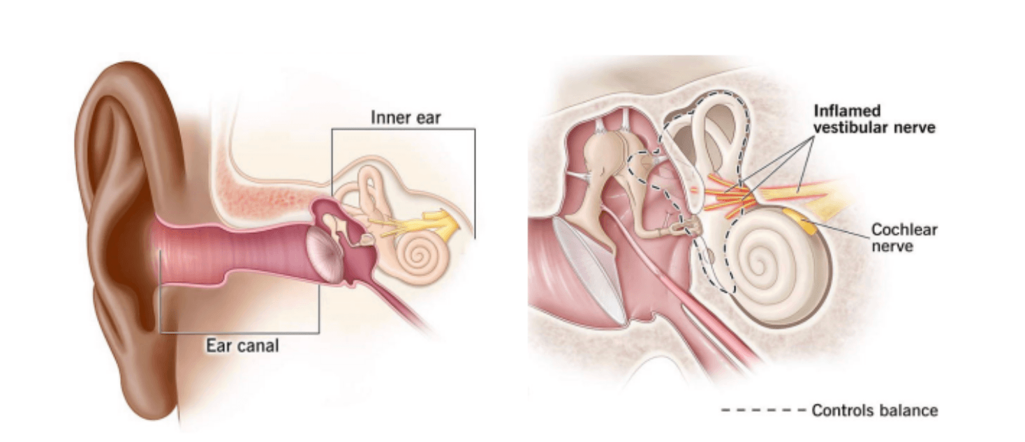 Vestibular Neuritis Image 1