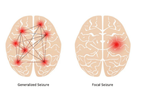 Epilepsy Image 2