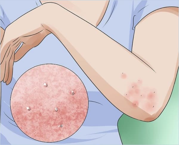 Scabies Image