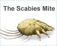 Scabies Image 2