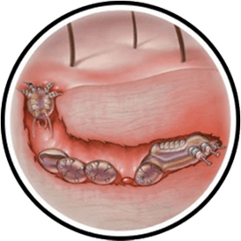 Scabies Image 3
