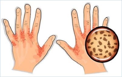 Scabies Image 4