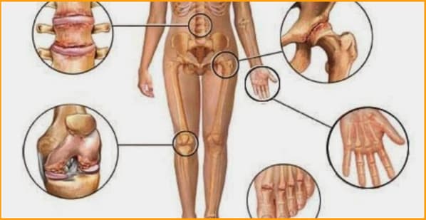 rheumatoid arthritis image 1