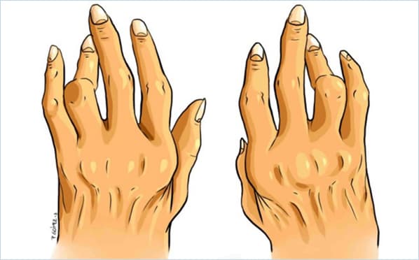 rheumatoid arthritis image 4