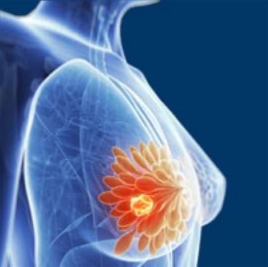 Breast Biopsy Image 3