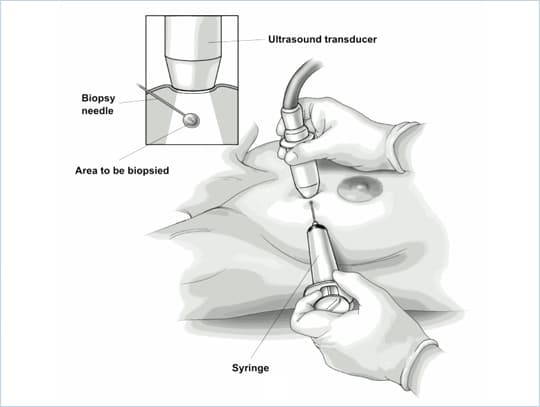 Breast Biopsy Image 6