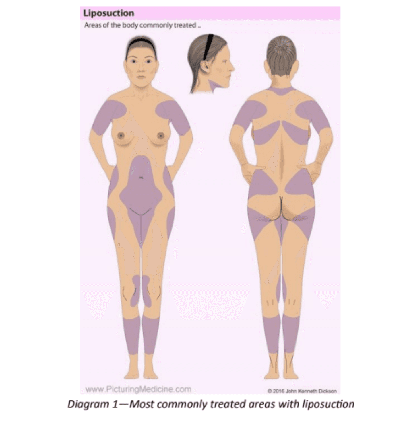 Liposuction Surgery Image 1
