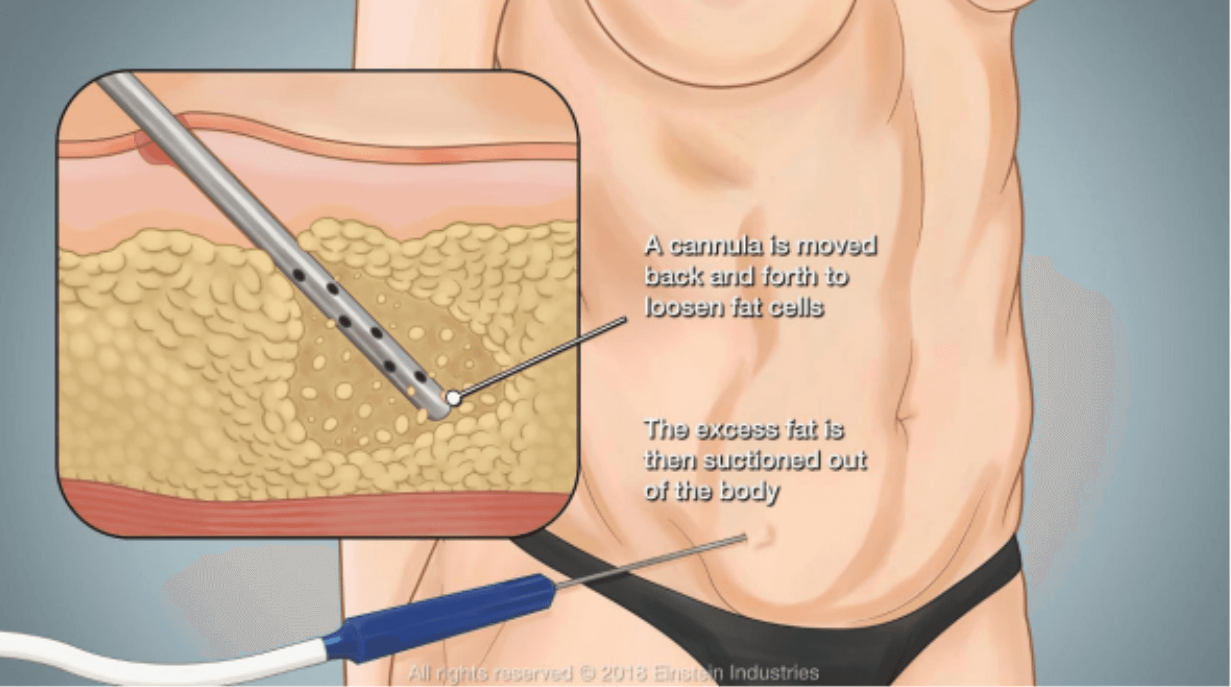 Liposuction Surgery Image 2
