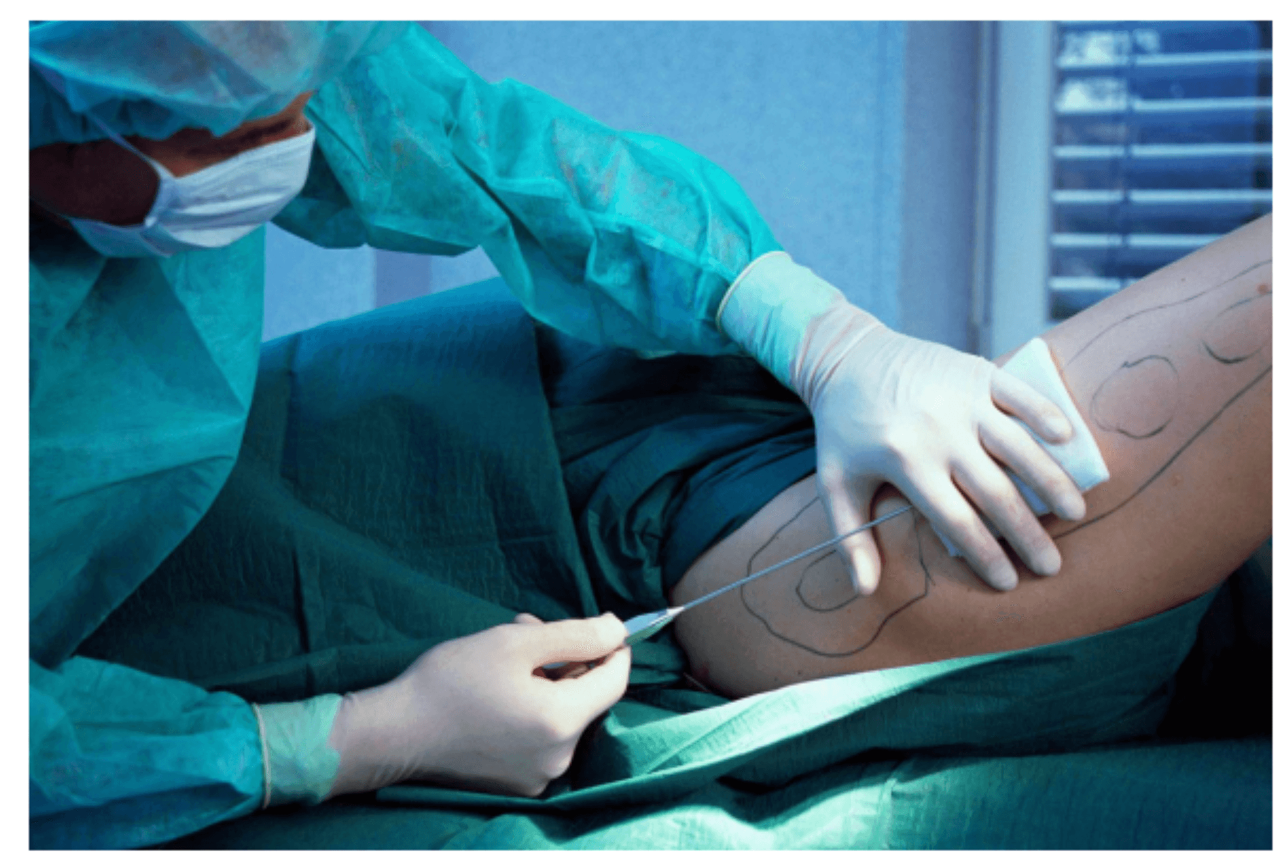 Liposuction Surgery Image 5