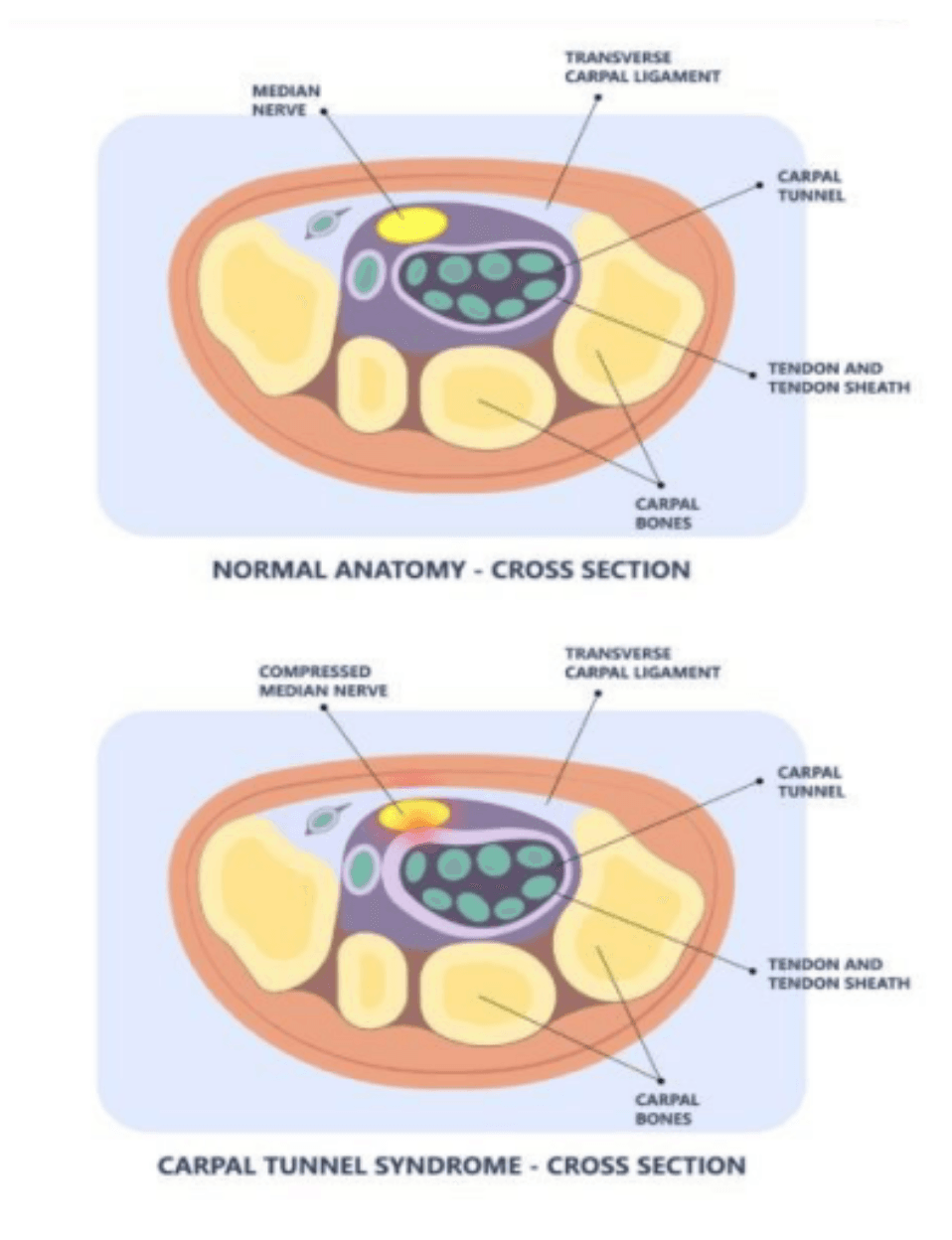 Carpel Tunnel Syndrome Image 1