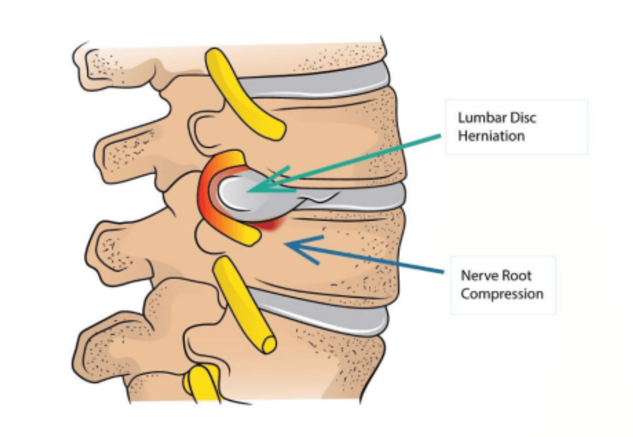 Herniated Lumbar Disc Image 1